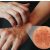 Eczema