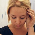 Alopecia areata