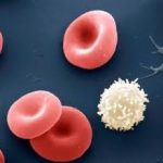 Anemia